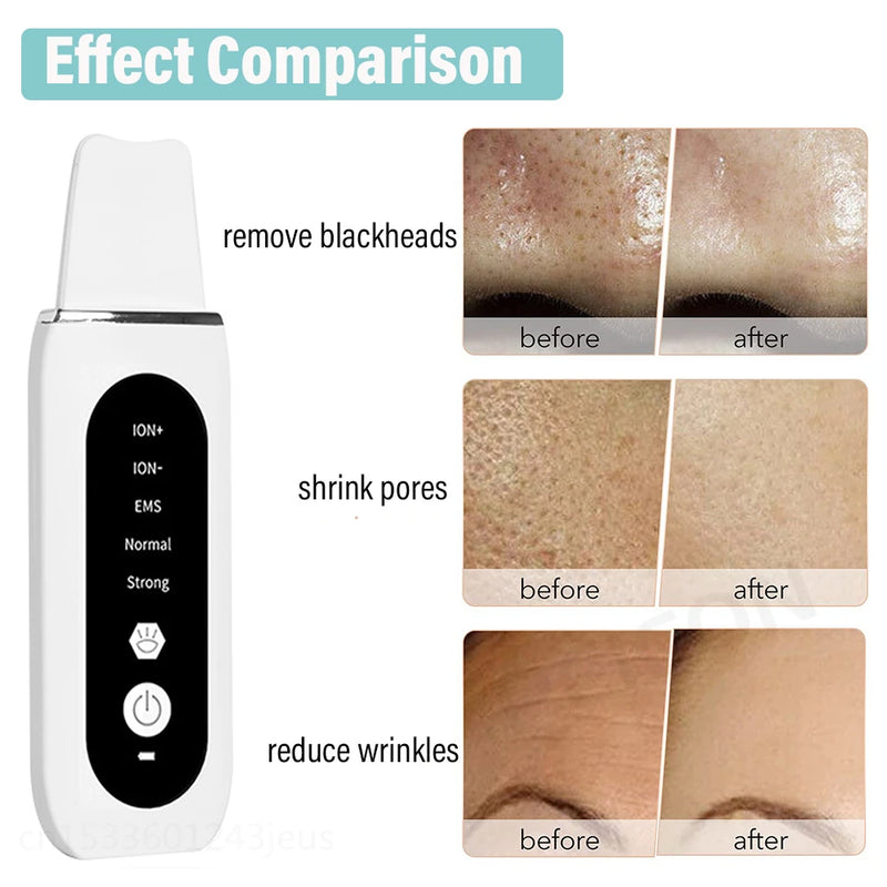 Esfoliante ultrassônico para pele, limpeza profunda ultrassônica do rosto, peeling, removedor de cravos, pá de limpeza facial, lifting, cuidados com a pele