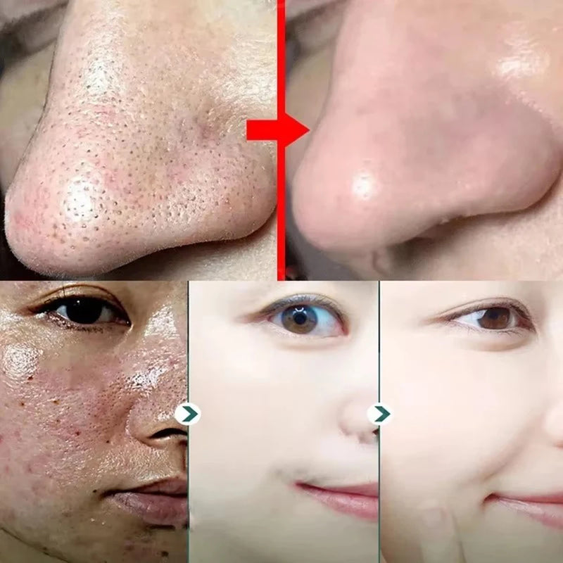 Máscara Facial Original Removedora de Cravos e Chá Verde Sólida, Trata Acne, Manchas e Pontos Pretos, Creme em Bastão para Limpeza, Diminui Poros e Cuidados com a Pele