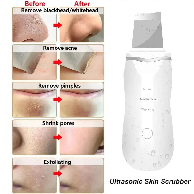 Esfoliante ultrassônico para pele, peeling, removedor de cravos, limpeza profunda do rosto, limpador de poros de acne, pá facial, limpador EMS de microcorrente